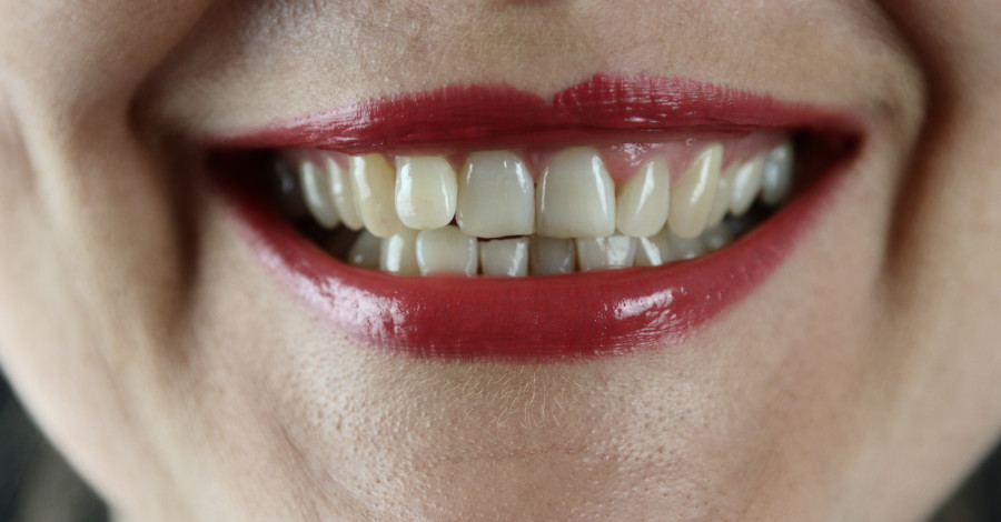 Zubné implantáty: Čo obnášajú a ako sa o ne starať?